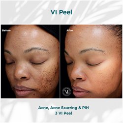 KGLO-Aesthetics - VI Peel treatment for acne scarring