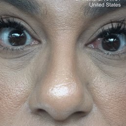 Eye infection due to the lash technician horrible service!! DO KOT GO HERE Eye infection due to the lash technician horrible service!! DO KOT GO HERE