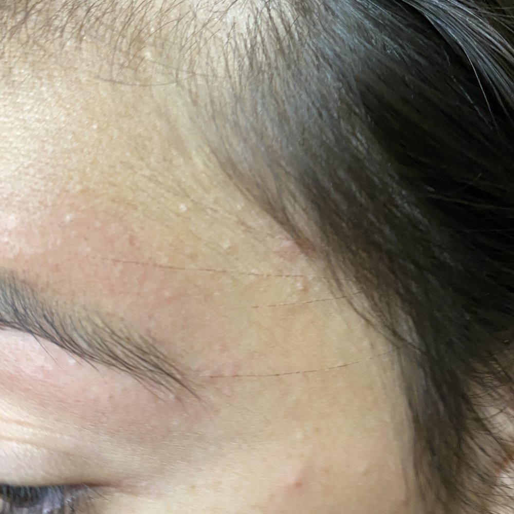 Cuts/scratches from the threading Cuts/scratches from the threading