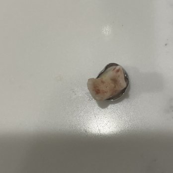 Come Dental - Failed silver crown - General Dentistry Near Me - Englewood, New Jersey