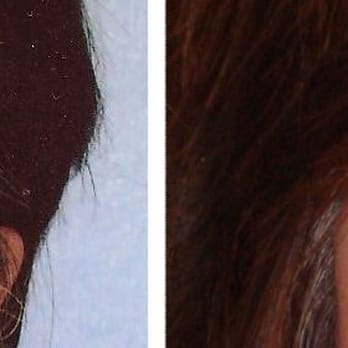 Kimberly Cockerham, MD - Before and after internal (posterior) ptosis repair - Cosmetic Surgeons Near Me - Stockton, California