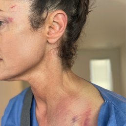 Broken in half collarbone (clavicle) Broken in half collarbone (clavicle)