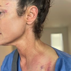 Natividad Medical Center - Broken in half collarbone (clavicle)