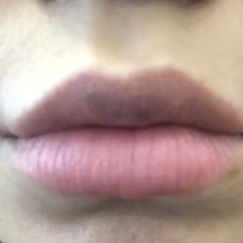 BioSpa - The day after! A bit of bruising but it's easy to hide with lipstick - Medical Spas Near Me - Newport Beach, California