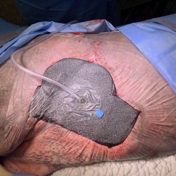 UC Davis Veterinary Teaching Hospital - Woundvac after first surgery @ UC Davis trying to reduce wound - Veterinarians Near Me - Davis, California