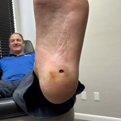 Lakes Foot & Ankle Specialists - Hole where wart was