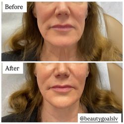 Beauty Goals LV - Facial rejuvenation