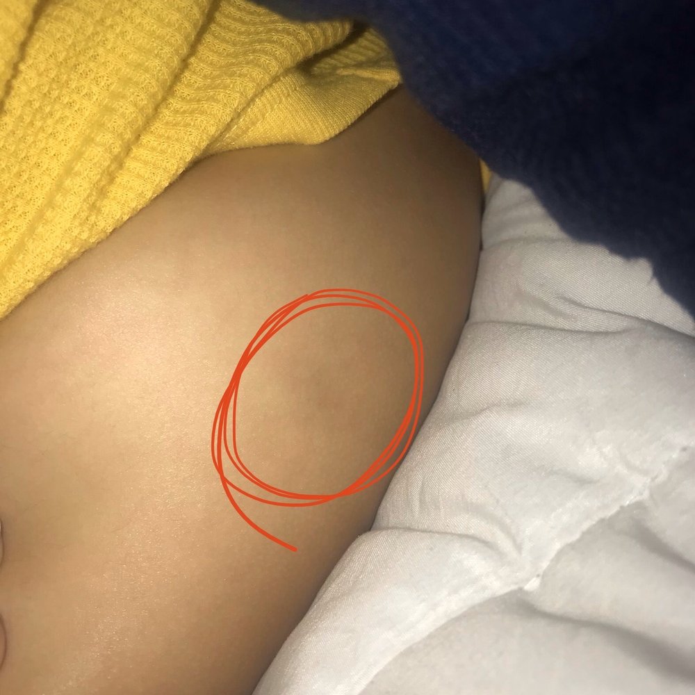 Two months after vaccines and his leg looks bruised in the area where given.