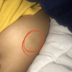 California Pediatrics - Two months after vaccines and his leg looks bruised in the area where given.