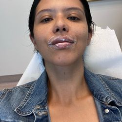 Lip numbing before filler