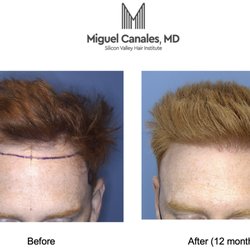Silicon Valley Hair Institute - Natural aesthetic hairlines