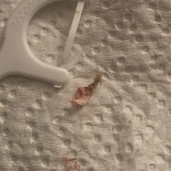 Smile Country Dental - Bone spicule that gave me an infection that ended up spreading to my lungs and stomach..