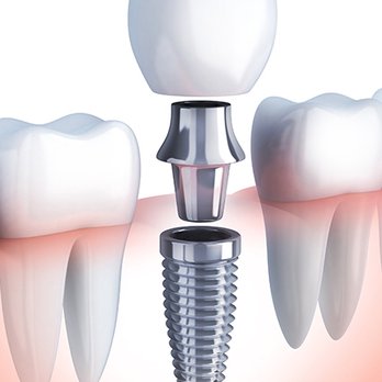 Plaza Dentistry - Dental Implants Expert in Santa Fe - Cosmetic Dentists Near Me - Santa Fe, New Mexico