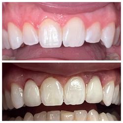 Family Smile Dental - Veneers to match existing teeth