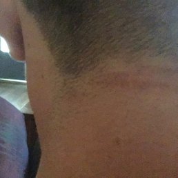 This is the back of my neck where Angel cut me. This is the back of my neck where Angel cut me.