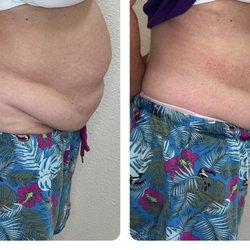 Only 4 sessions with cavitation.