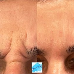 Aroma Spa & Laser Center - Botox for those lines of expression
