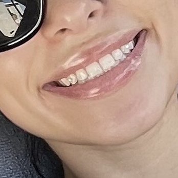 Rob Berberian, DO - and AFTER! fuller top lip (looks even better with lip liner) & no more gummy smile! - Cosmetic Surgeons Near Me - Newport Beach, California