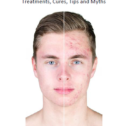 The Acne Clinic at Beach Cities Dermatology - Steven Leon's Acne Guidebook. Download it now on the website!