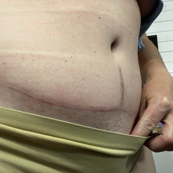 Regional Plastic Surgery Center - Scar and fupa caused by Dr Byrnes - Cosmetic Surgeons Near Me - Dallas, Texas Regional Plastic Surgery Center - Scar and fupa caused by Dr Byrnes - Cosmetic Surgeons Near Me - Dallas, Texas
