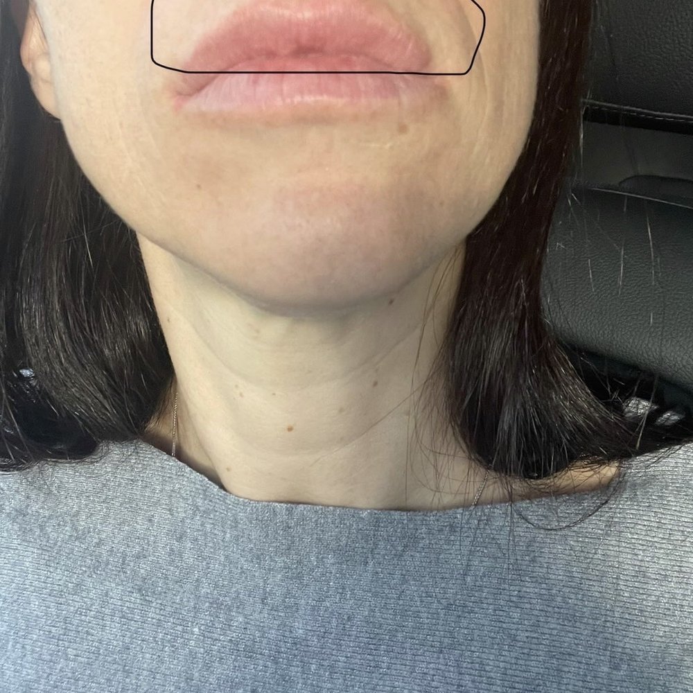 Lazer Lounge - The filler they did for me ... It's not even on my lip - Laser Hair Removal Near Me - Studio City, California Lazer Lounge - The filler they did for me ... It's not even on my lip - Laser Hair Removal Near Me - Studio City, California