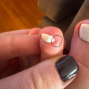 True Nails - Infected toe - Nail Salons Near Me - Kingsport, Tennessee True Nails - Infected toe - Nail Salons Near Me - Kingsport, Tennessee