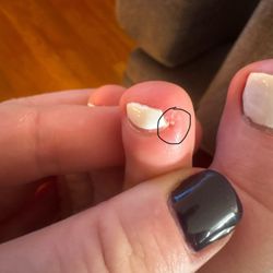 True Nails - Infected toe