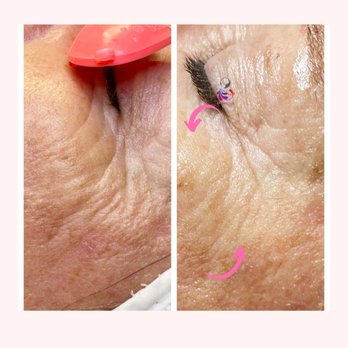 818 Skincare Studio - Before and After - Skin Care Near Me - Tustin, California 818 Skincare Studio - Before and After - Skin Care Near Me - Tustin, California