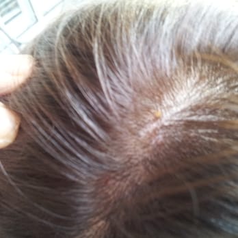 Elon Salon - chemically-burned scalp from BAD hair color mixing! - Hair Stylists Near Me - Marietta, Georgia Elon Salon - chemically-burned scalp from BAD hair color mixing! - Hair Stylists Near Me - Marietta, Georgia
