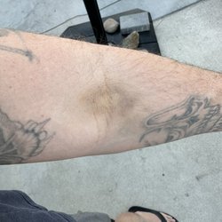 Quest Diagnostics - Bruises