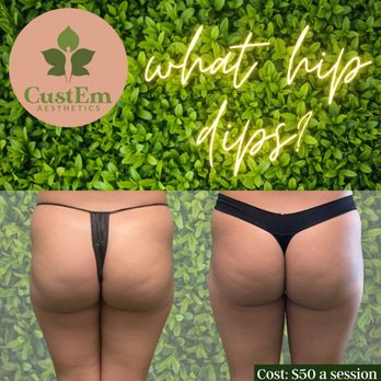 CustEm Aesthetics - Body Sculpting buttocks enhancement - Body Contouring Near Me - Fremont, California CustEm Aesthetics - Body Sculpting buttocks enhancement - Body Contouring Near Me - Fremont, California