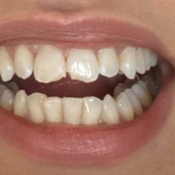 Ronald A Maple, DDS - Corneliuis Pass Dental Excellence - Before