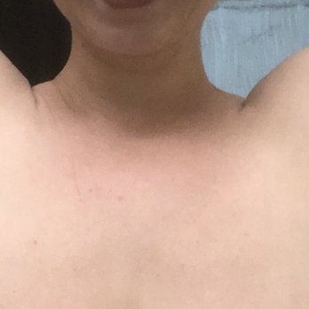 Artemedica - How swollen my arm pits were the next day. - Medical Spas Near Me - Santa Rosa, California Artemedica - How swollen my arm pits were the next day. - Medical Spas Near Me - Santa Rosa, California