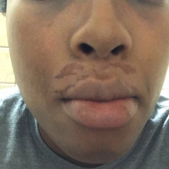 Rapid Wax - Day 2, the next day and scars - Eyebrow Services Near Me - Miami, Florida