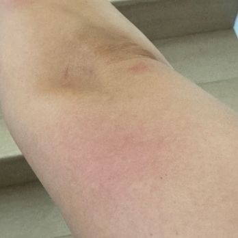 Aspire Wellness Studio - Bug bites - Yoga Near Me - La Habra, California Aspire Wellness Studio - Bug bites - Yoga Near Me - La Habra, California