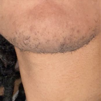 Prime Aesthetics Electrolysis - Hair Removal Near Me - Rockwall, Texas Prime Aesthetics Electrolysis - Hair Removal Near Me - Rockwall, Texas