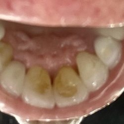 Riverfront Dental Care - Uneven from drill and plaque stains