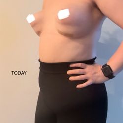Michael A Fiorillo, MD - Reflections Medical - Today - after second surgery. Double bubble