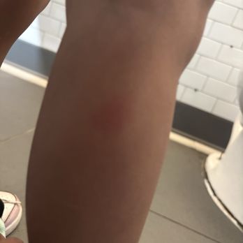 Holiday Inn Express - Bite mark on my other daughter - Hotels Near Me - San Diego, California Holiday Inn Express - Bite mark on my other daughter - Hotels Near Me - San Diego, California