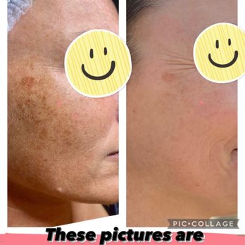 Glo Aesthetics by Caren - Cosmelan peel to remove pigmentation - Skin Care Near Me Glo Aesthetics by Caren - Cosmelan peel to remove pigmentation - Skin Care Near Me
