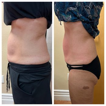 Elevate Wellness - Cryo Slimming Results!! This is after 4 sessions! - Cryotherapy Near Me - Coronado, California