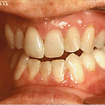 Tucker Dental Group - Resin Fillings (After) - General Dentistry Near Me - Daly City, California Tucker Dental Group - Resin Fillings (After) - General Dentistry Near Me - Daly City, California