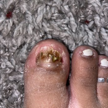 Classy Nails - 2-3weeks into healing - Nail Salons Near Me - Sacramento, California
