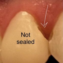 Germantown Dental - Where the bonding was literally not sealed.
