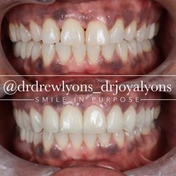 Smile Savvy Cosmetic Dentistry - 10 natural porcelain veneers