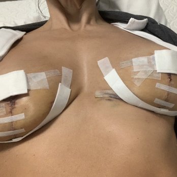 Andrew P Amunatequi, MD - 1 day post-op.  You can see the breasts were left still with a sag. - Cosmetic Surgeons Near Me - Miami, Florida