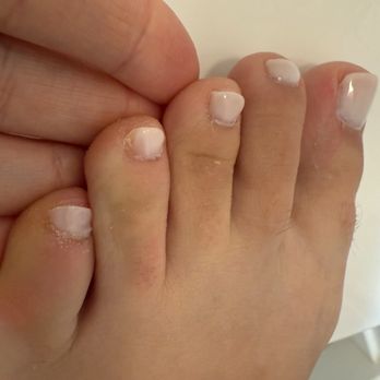 Xnails - No chip manicure - The image depicts a close-up of a person's toes, with visible white nail polish on the toenails. There is skin irritation and peeling around the nails, indicating possible dryness or skin condition. The background is neutral and out of focus. - Nail Salons Near Me - Downers Grove, Illinois