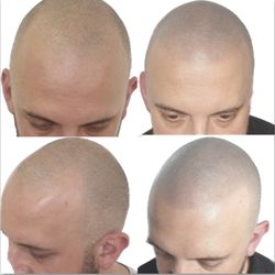 Scalp Micropigmentation. SMP. Hair loss. Hair solutions. Hair transplant. Salon near me. Mixxsalonhb