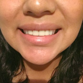 Adrian Sanchez, DDS - Permanent silicone crowns - General Dentistry Near Me - South Pasadena, California