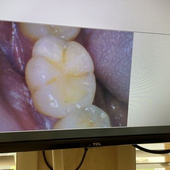 Gallagher & Kuhn Dental Group - Pics of teeth after abrasion has been completed- no filing yet - PLEASE NOTE- NO PAIN - Pediatric Dentists Near Me - Westminster, Maryland Gallagher & Kuhn Dental Group - Pics of teeth after abrasion has been completed- no filing yet - PLEASE NOTE- NO PAIN - Pediatric Dentists Near Me - Westminster, Maryland